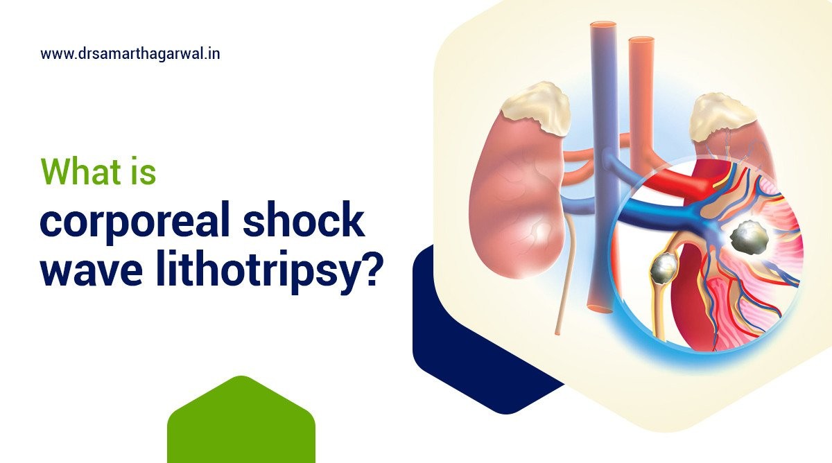 What is Corporeal Shock Wave Lithotripsy?