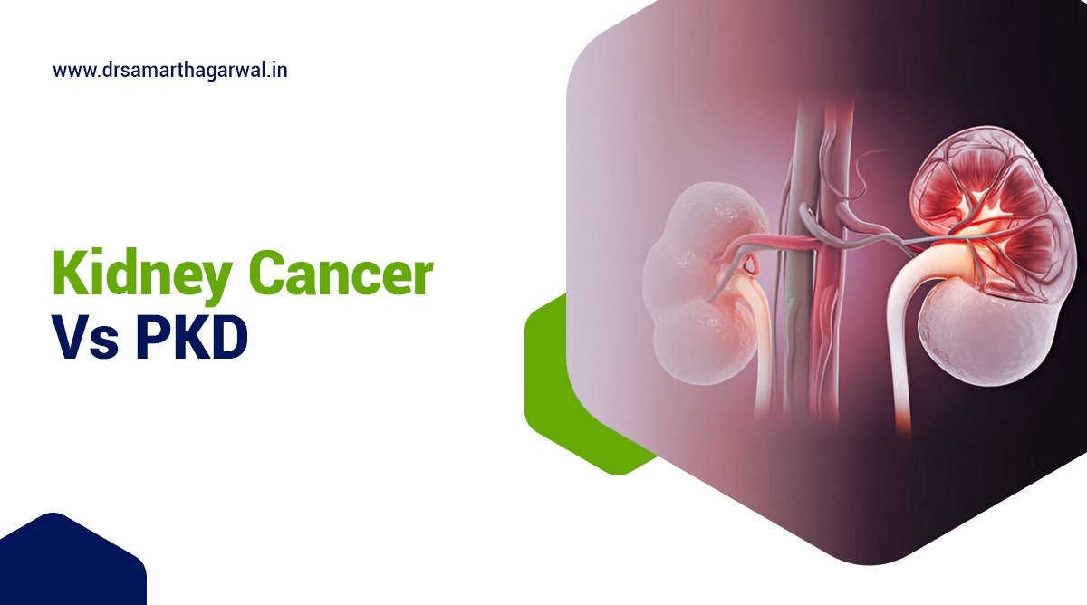 Kidney Cancer vs PKD (Polycystic Kidney Disease)