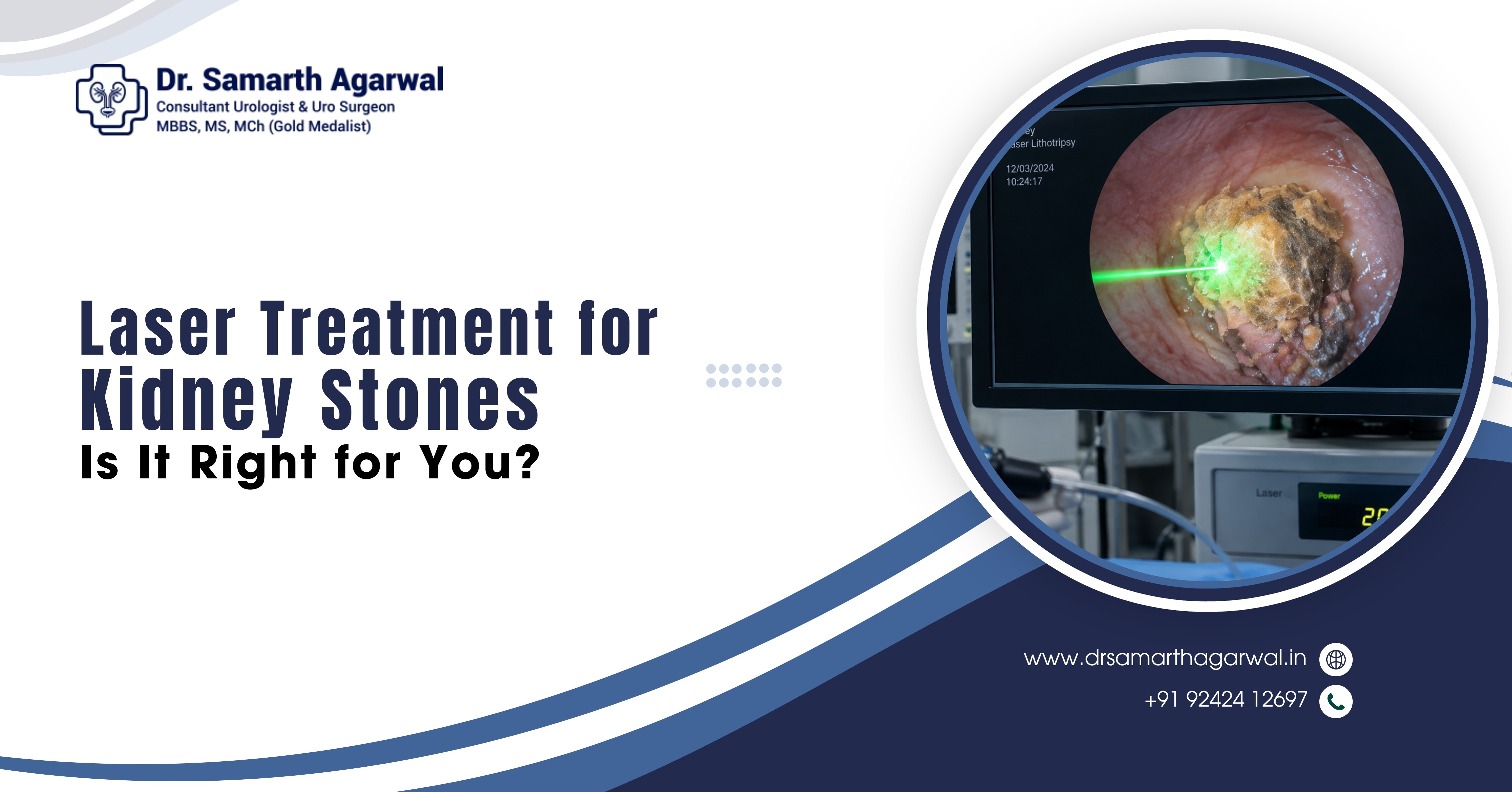 Laser Treatment for Kidney Stones: Is It Right for You?