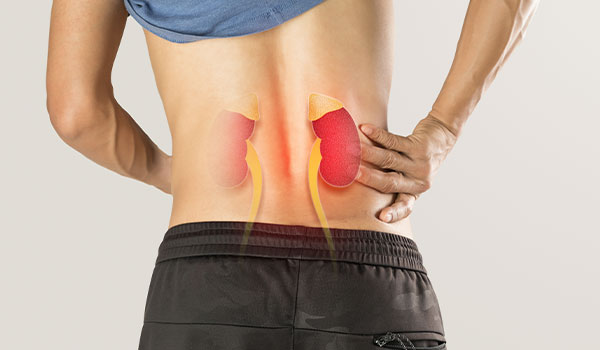 Patients with Kidney Stones