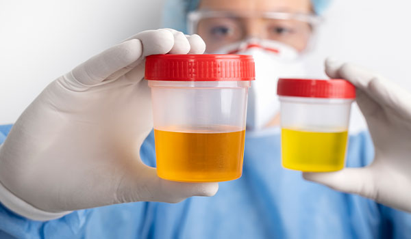 Urinalysis