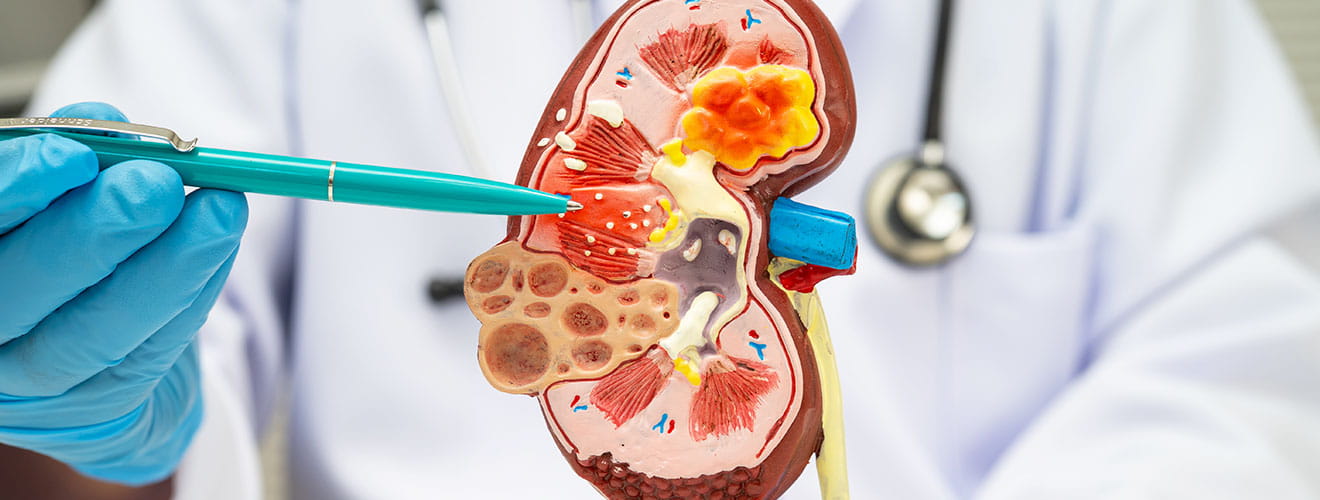 Kidney Stones