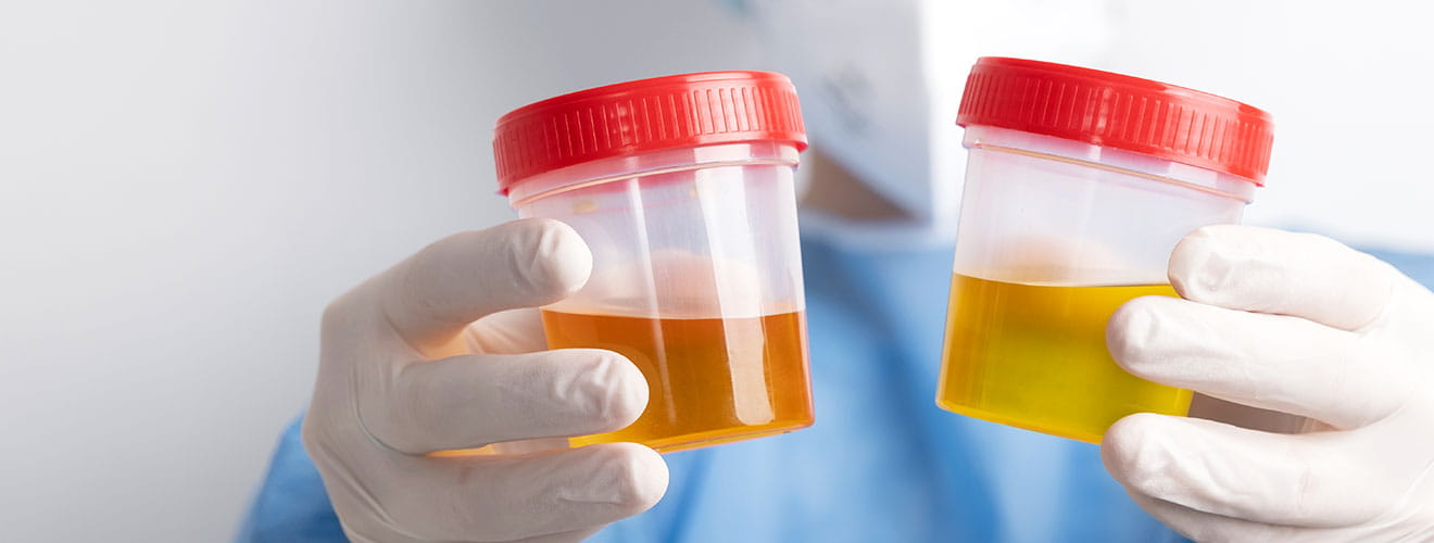 Blood in Urine