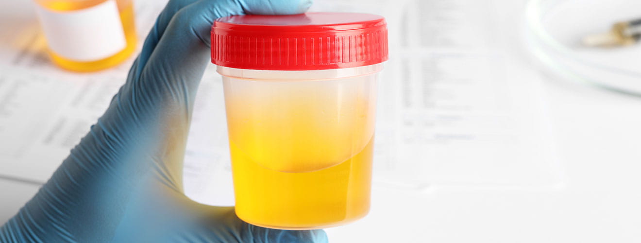 Cloudy Urine