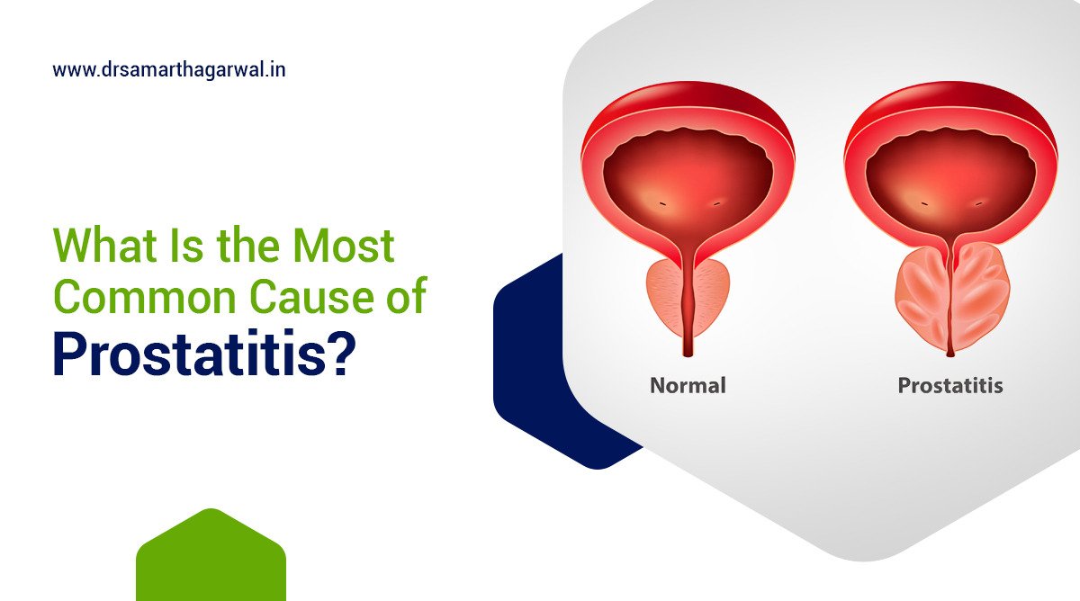 What Is the Most Common Cause of Prostatitis
